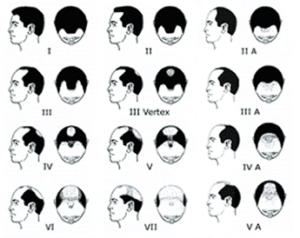 Hair Loss Causes - Hair Transplant Specialist