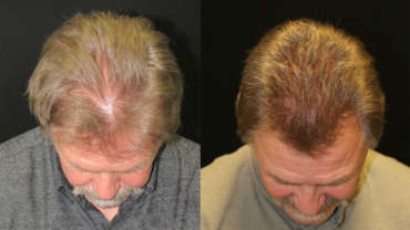 Non-Surgical Hair Restoration