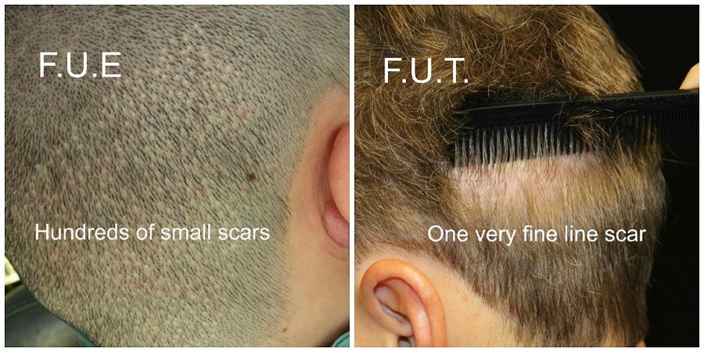 FUE vs. FUT - Hair Transplant Specialist