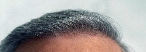 Microprecision Follicular Grafting®