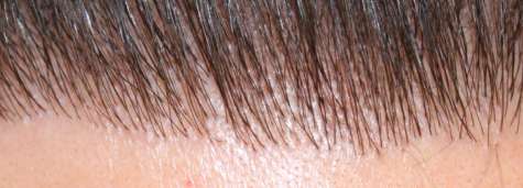 Microprecision Follicular Grafting®