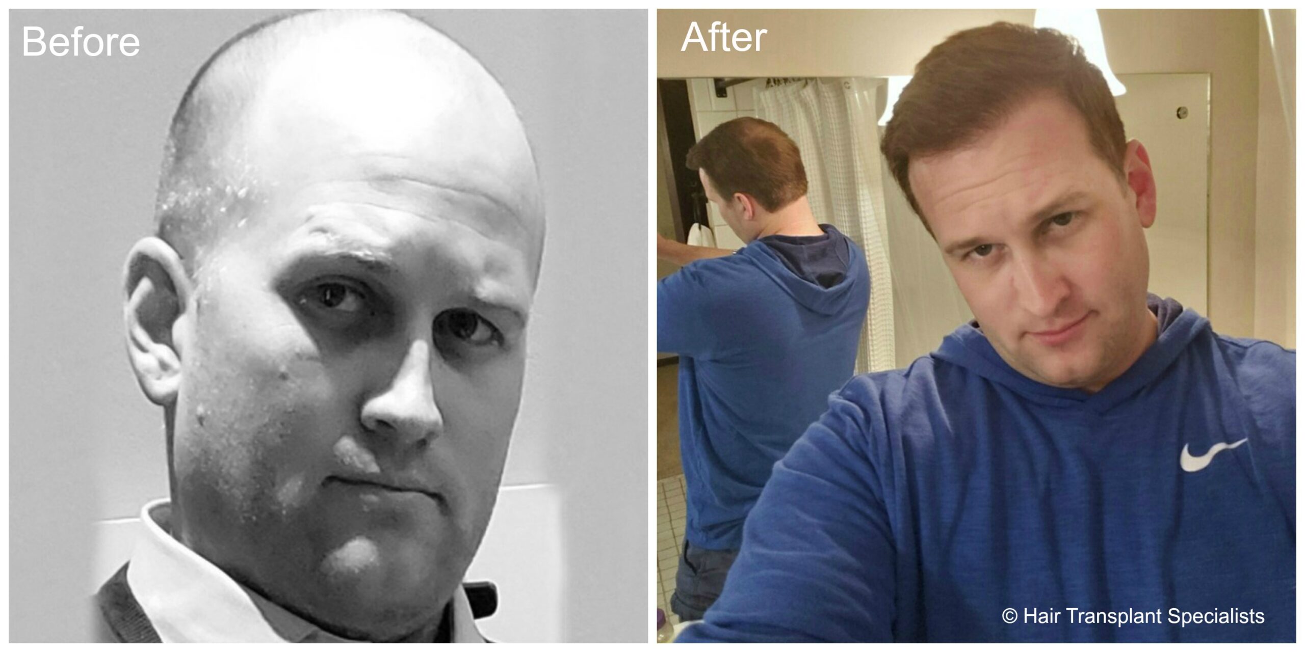 FUT hair transplant