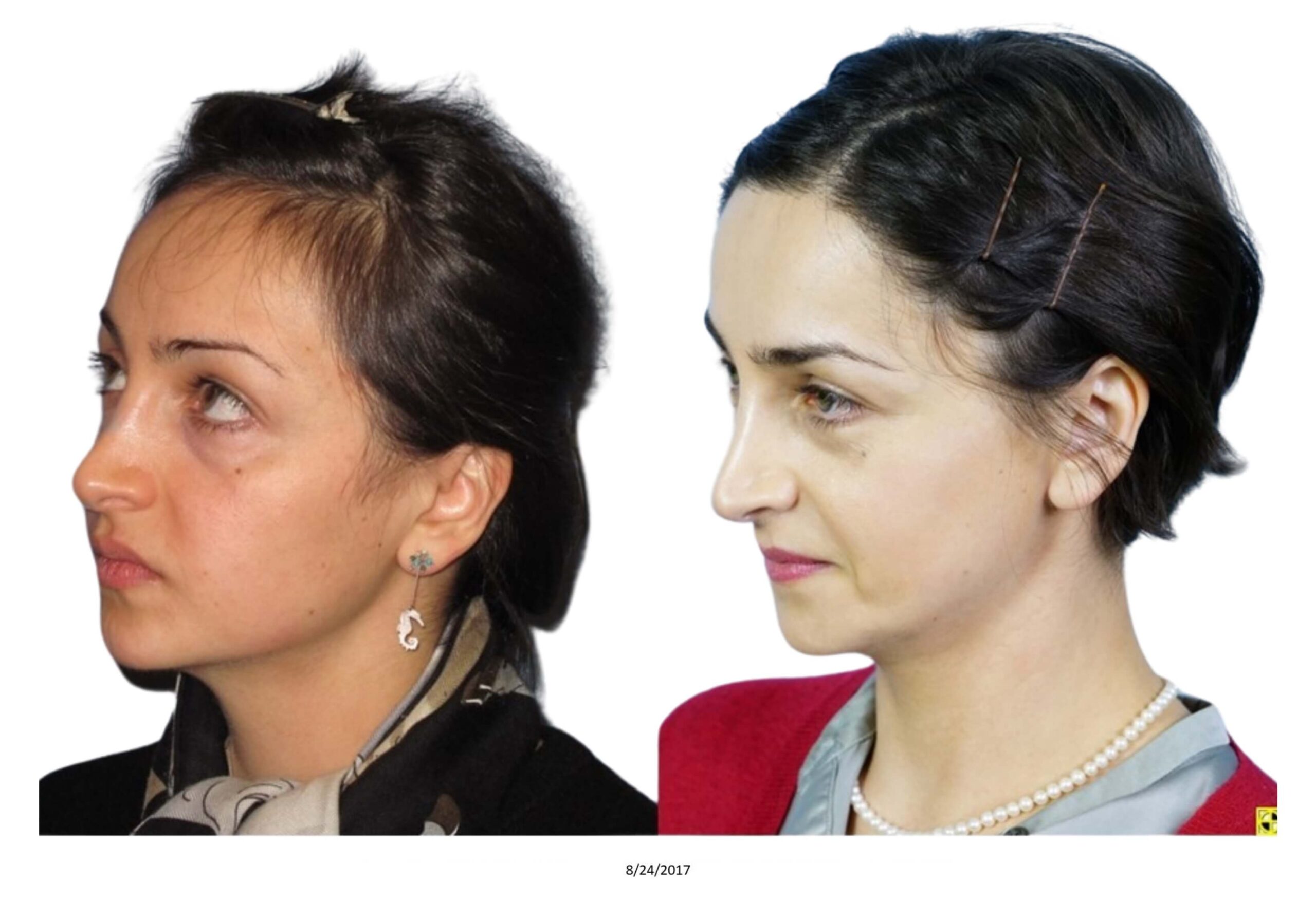 Female B&A_12_bw