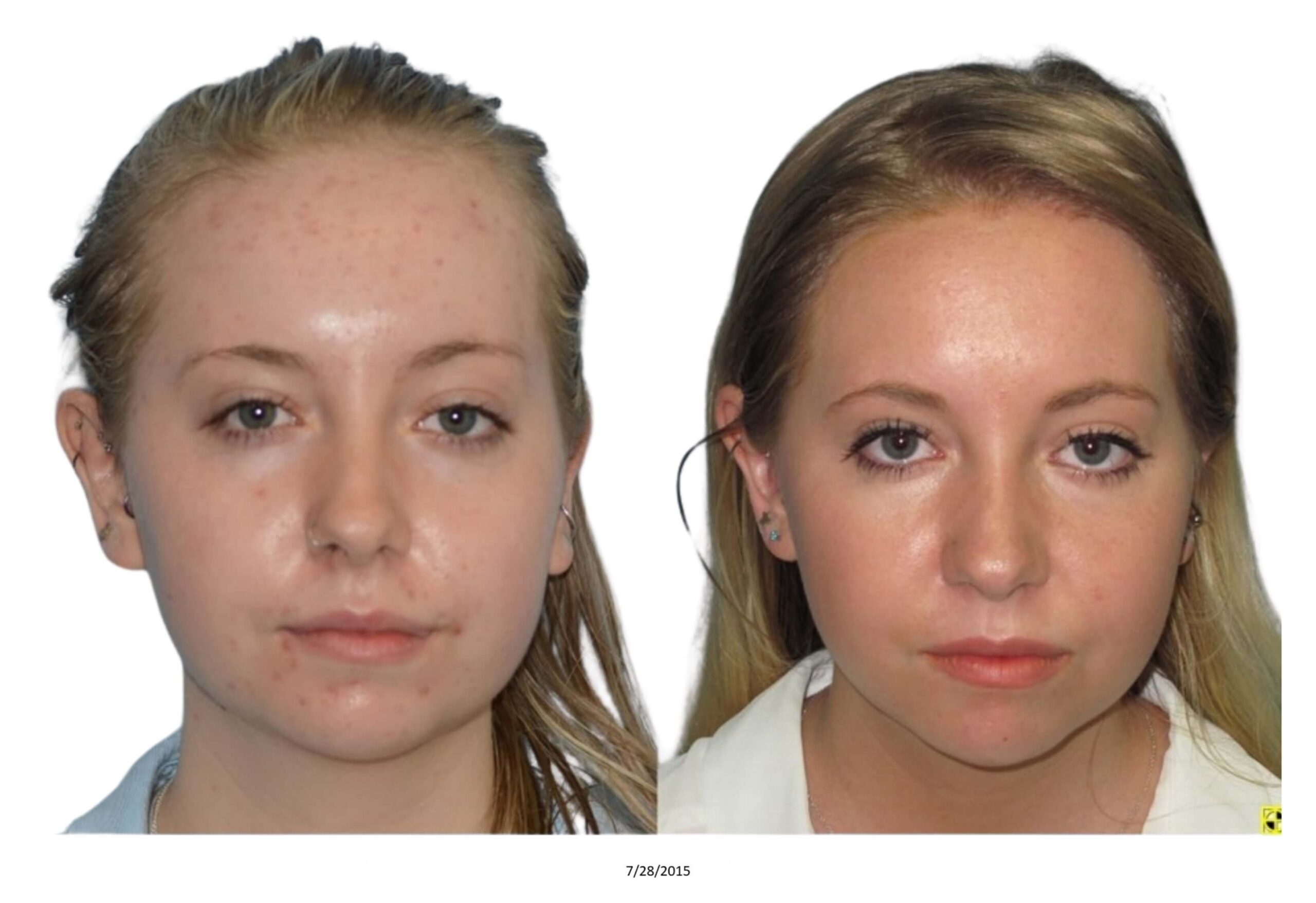 Female B&A_14_bw