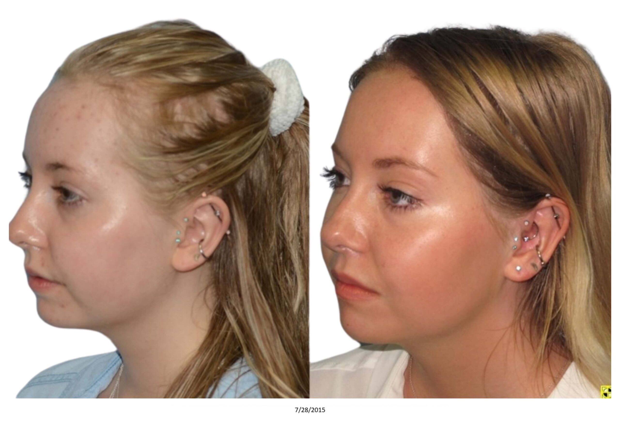 Female B&A_16_bw