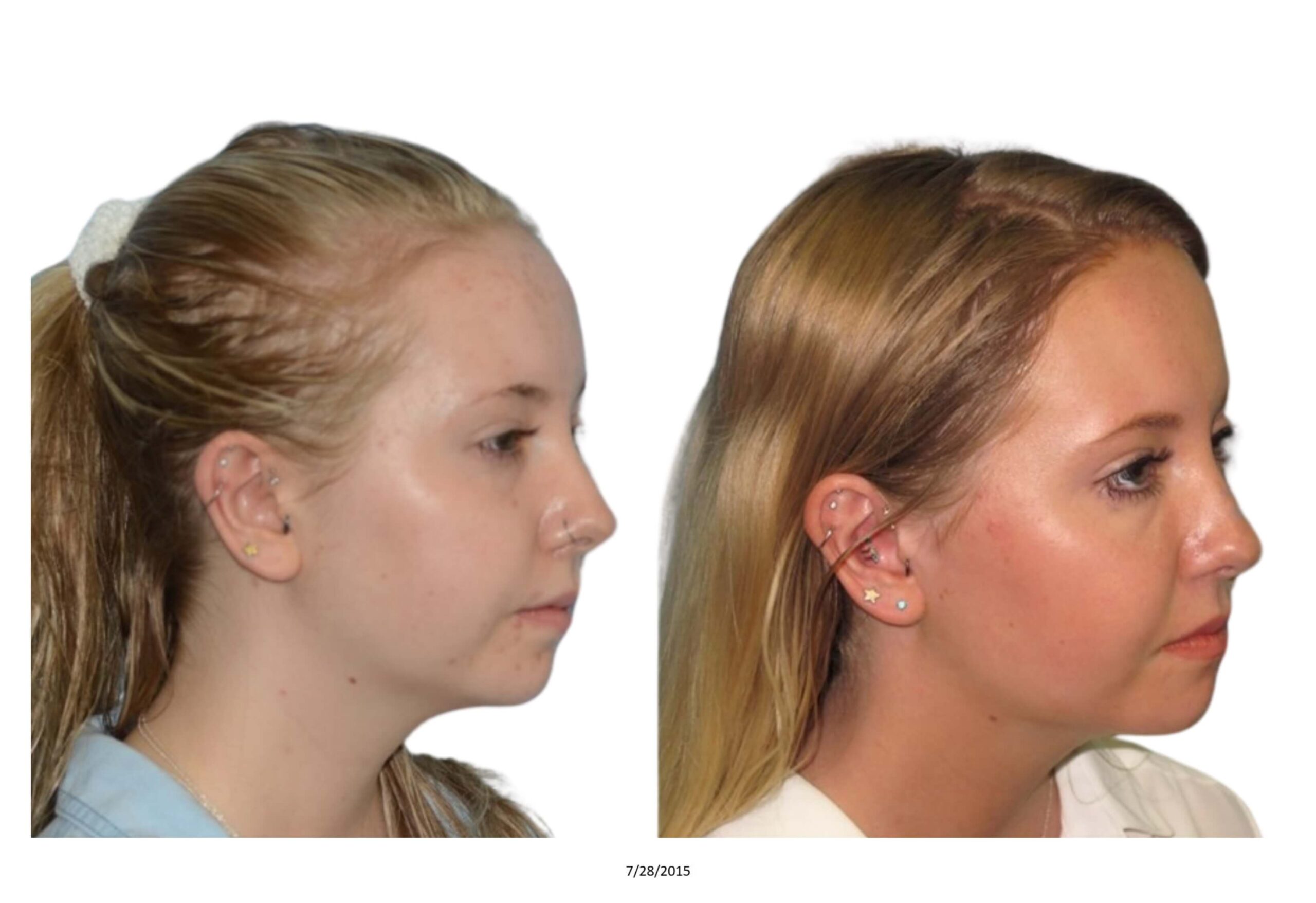 Female B&A_17_bw