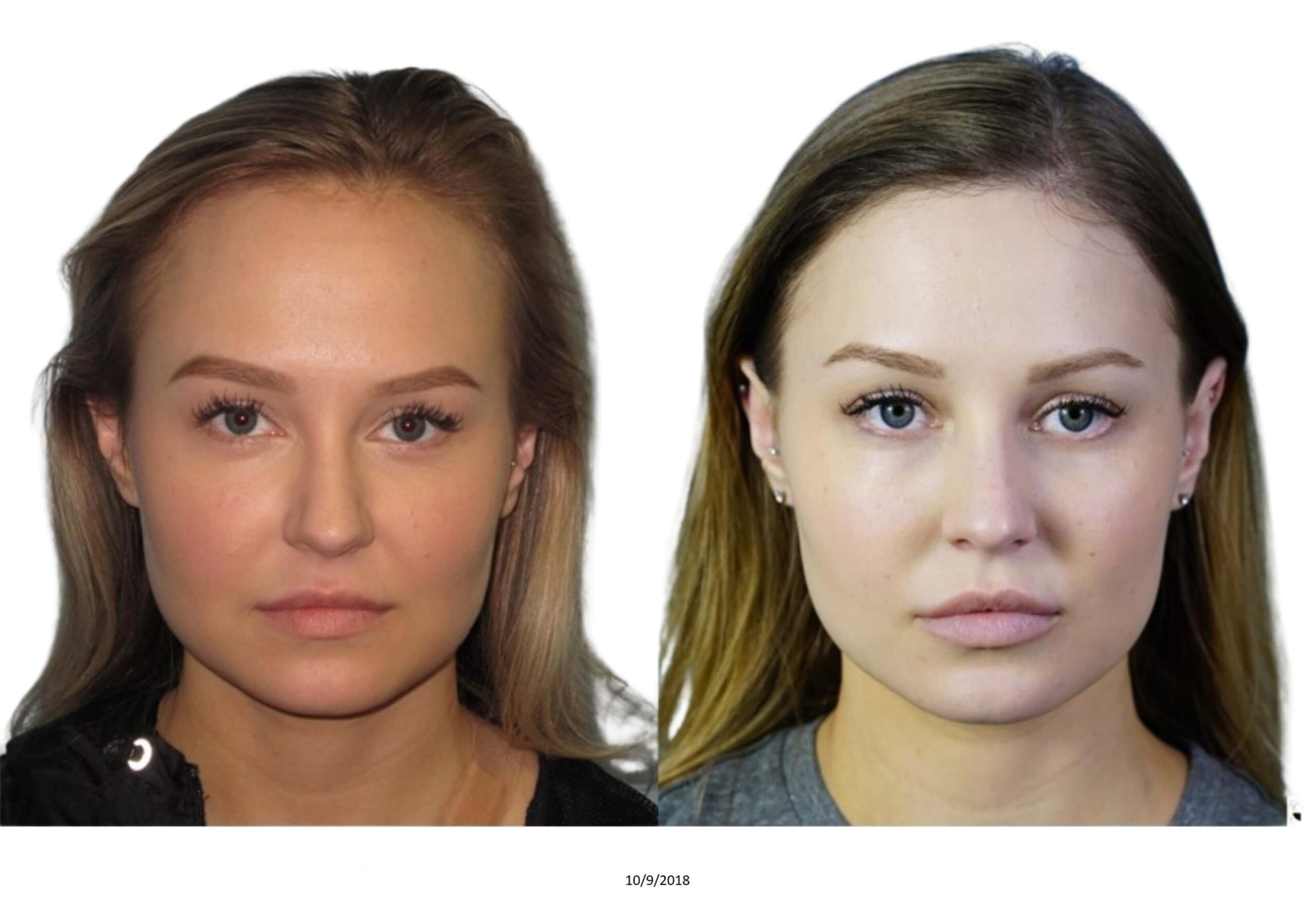 Female B&A_1_bw