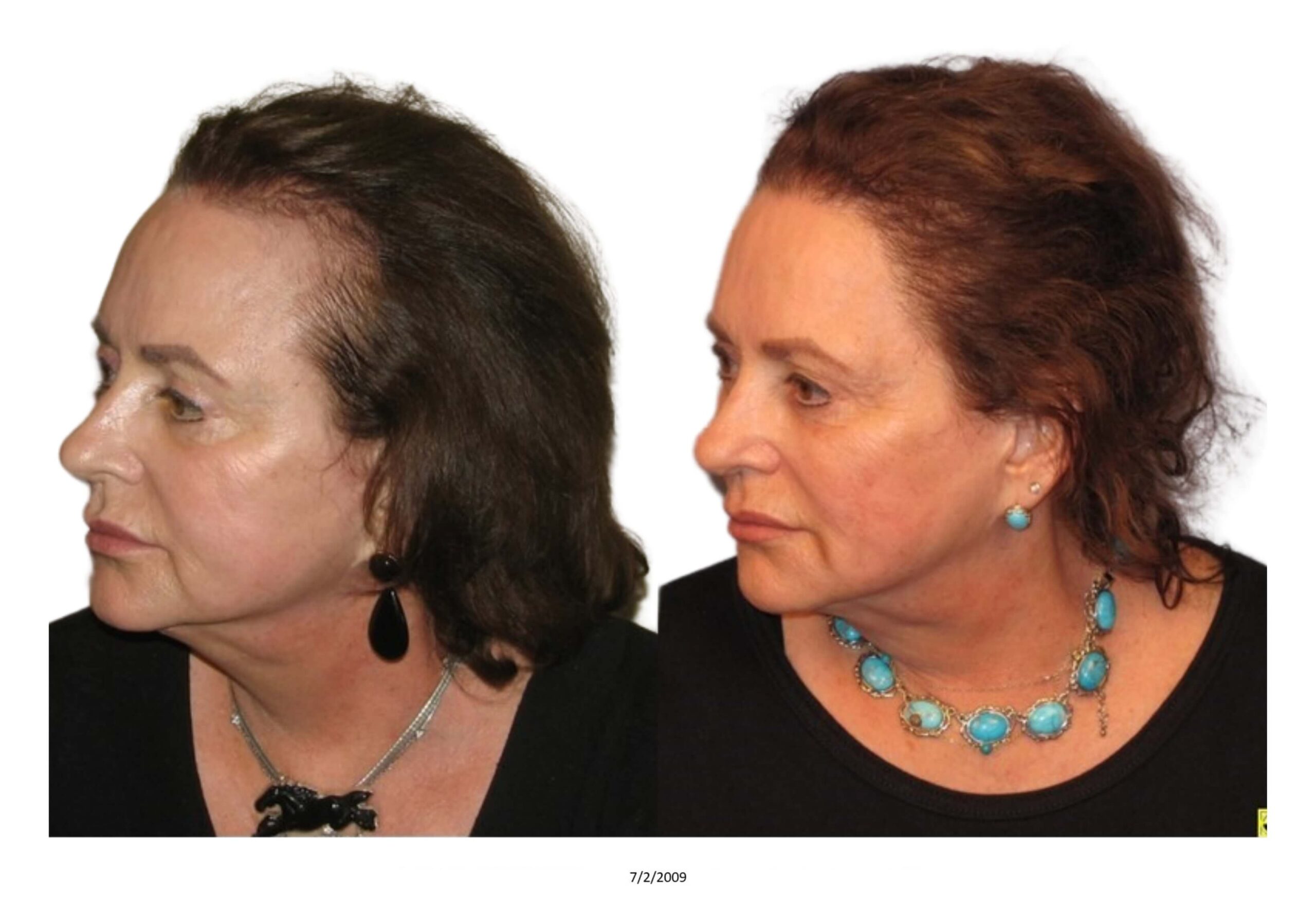 Female B&A_24_bw