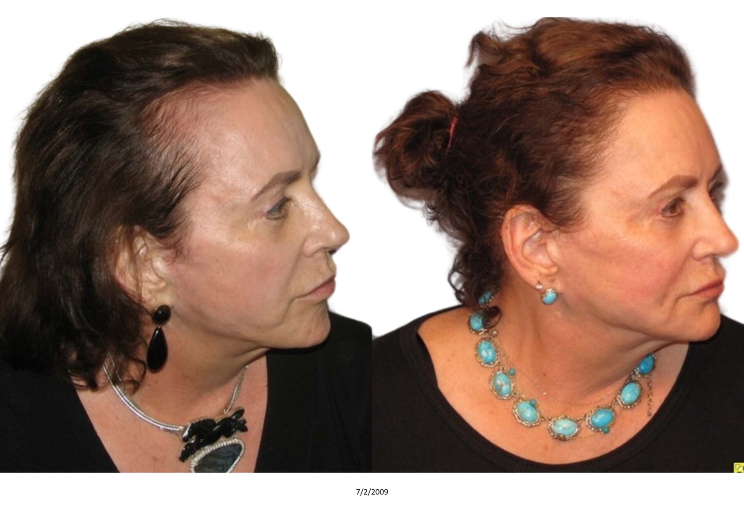 Female B&A_25_bw