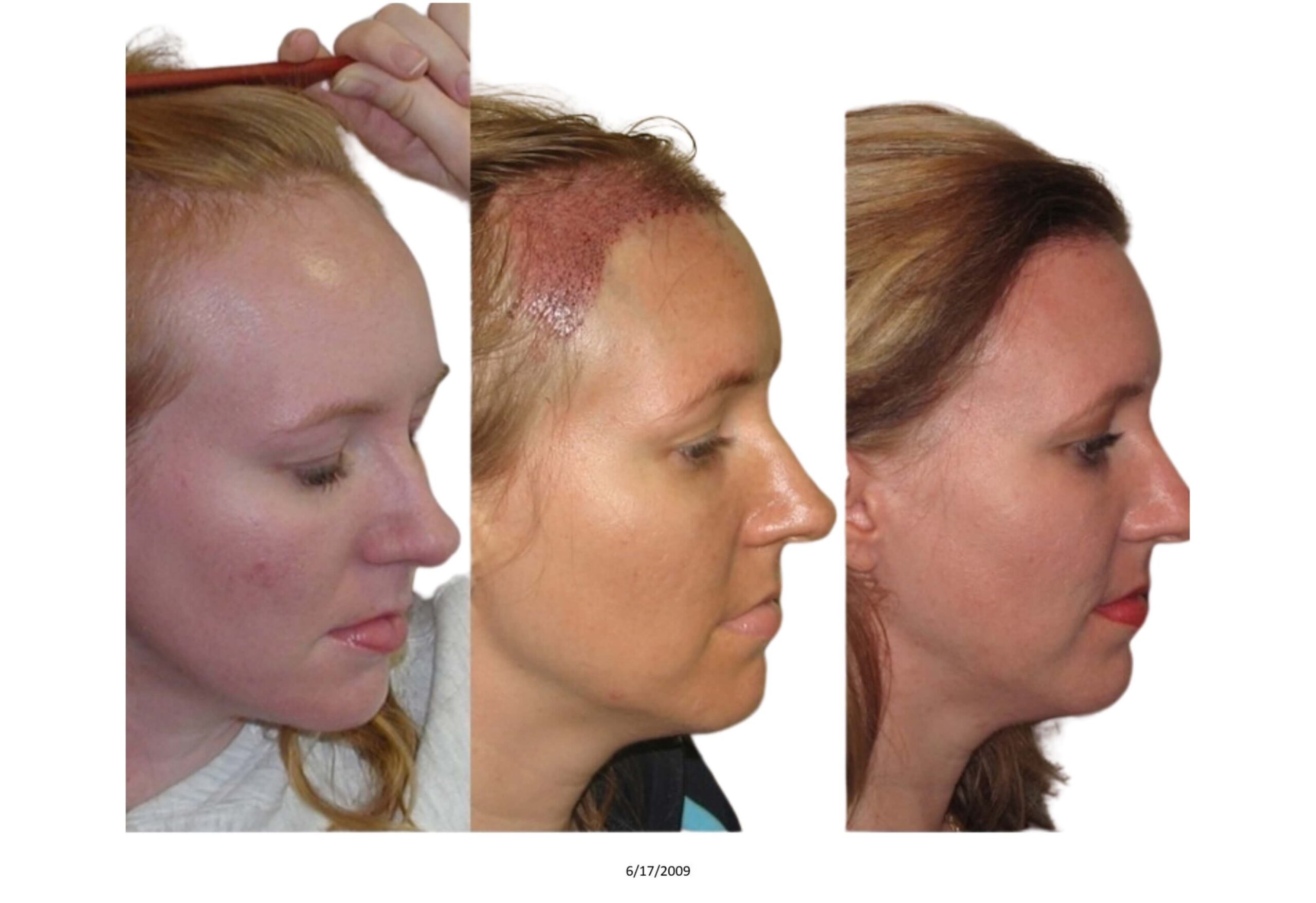 Female B&A_28_bw