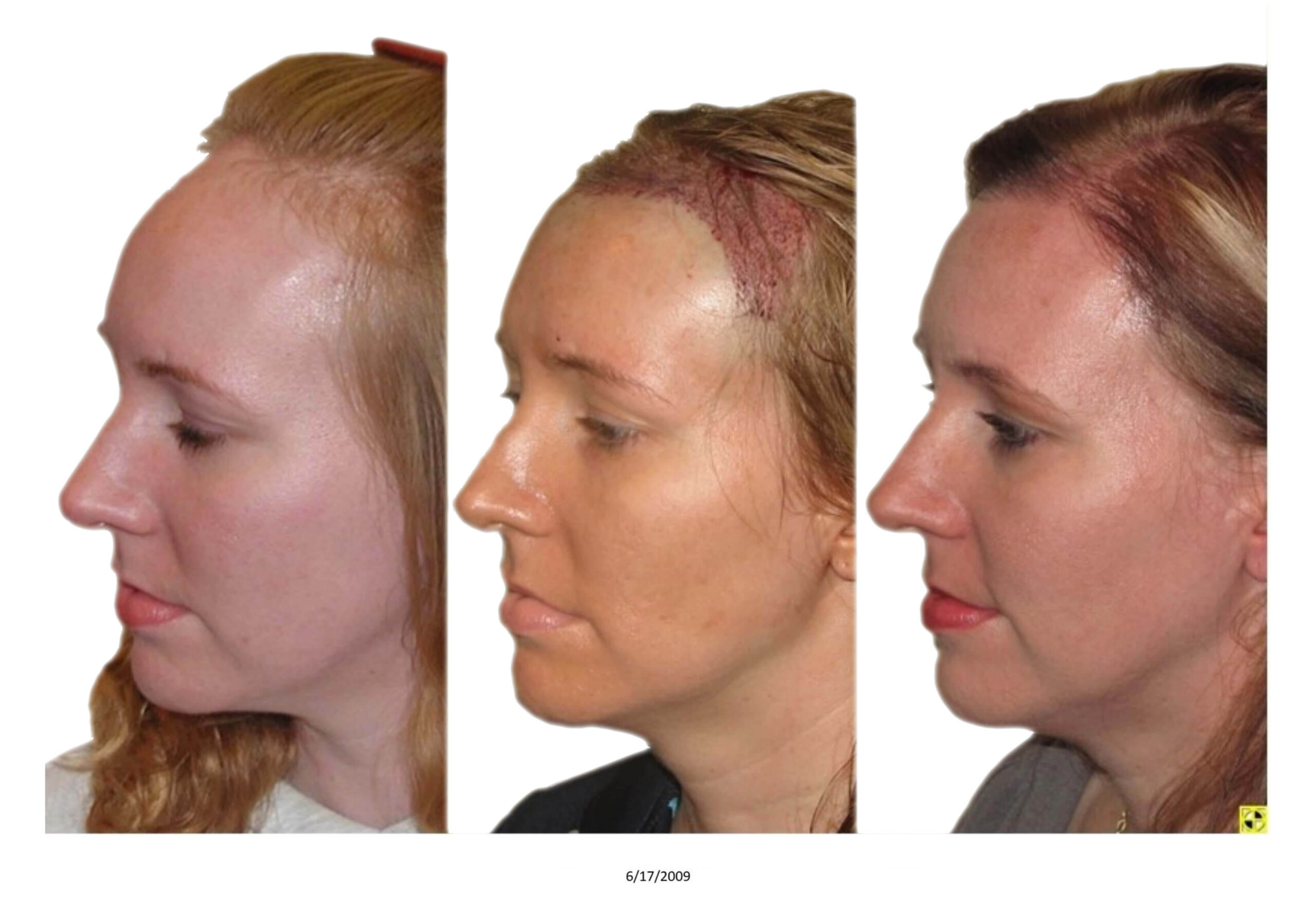Female B&A_29_bw