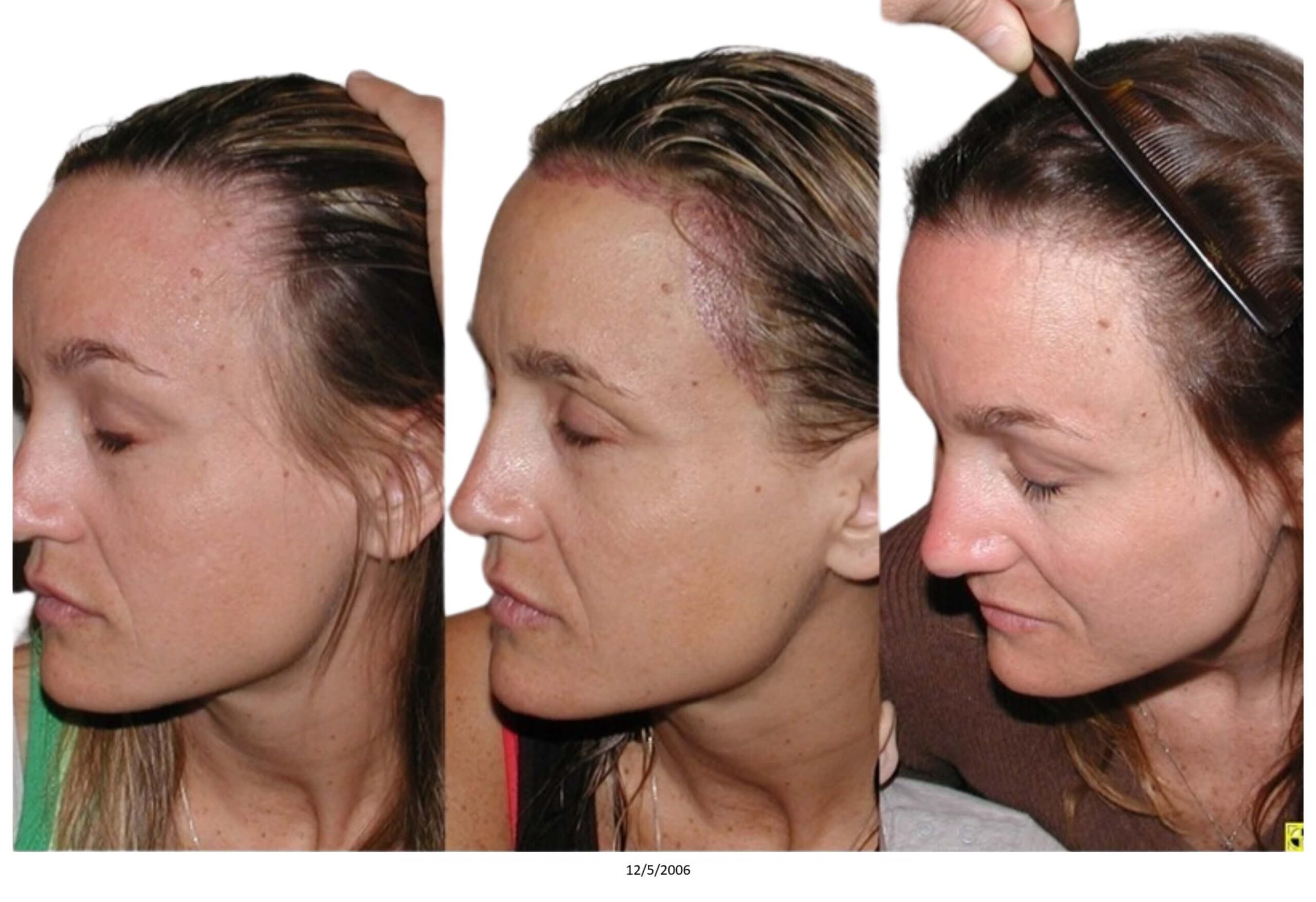 Female B&A_32_bw
