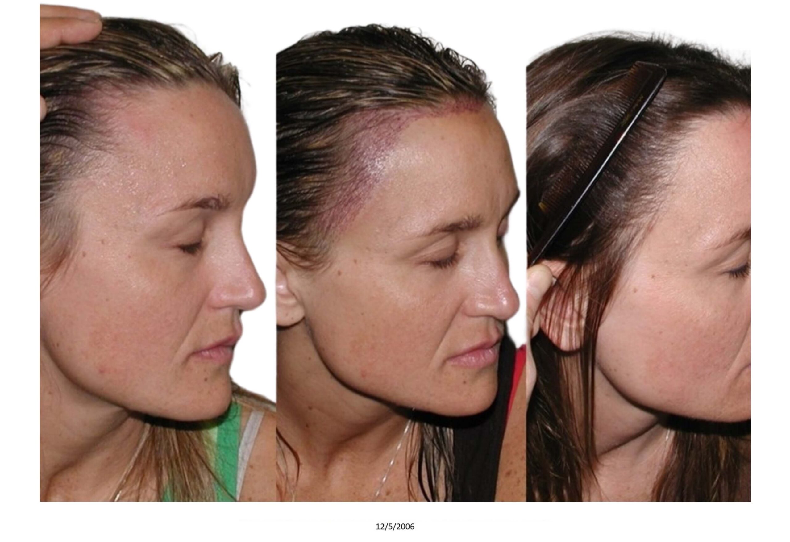 Female B&A_33_bw