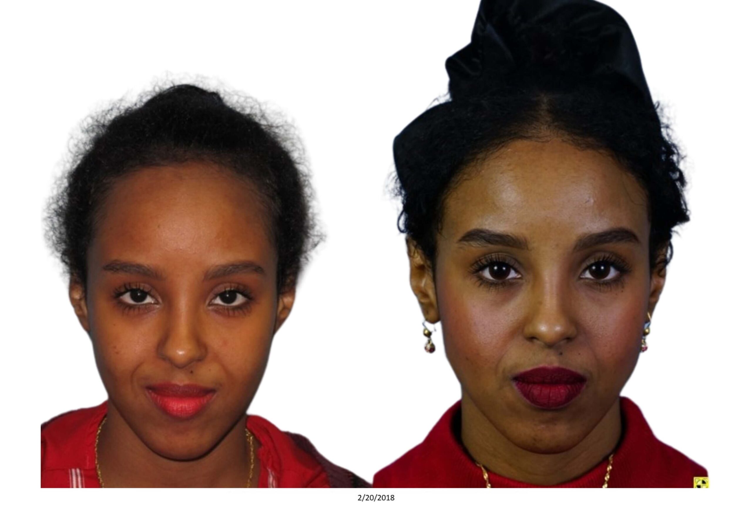 Female B&A_34_bw