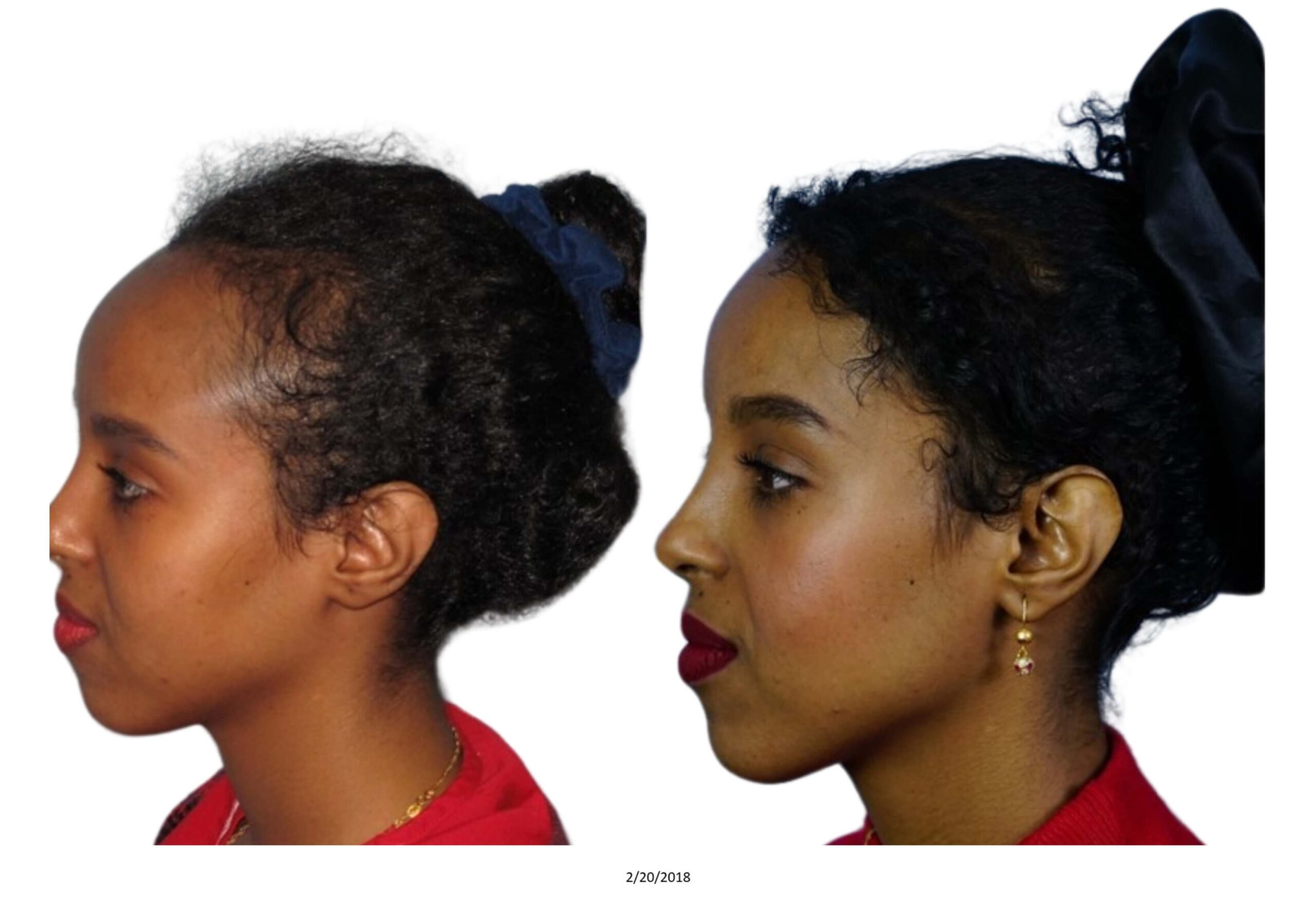 Female B&A_36_bw