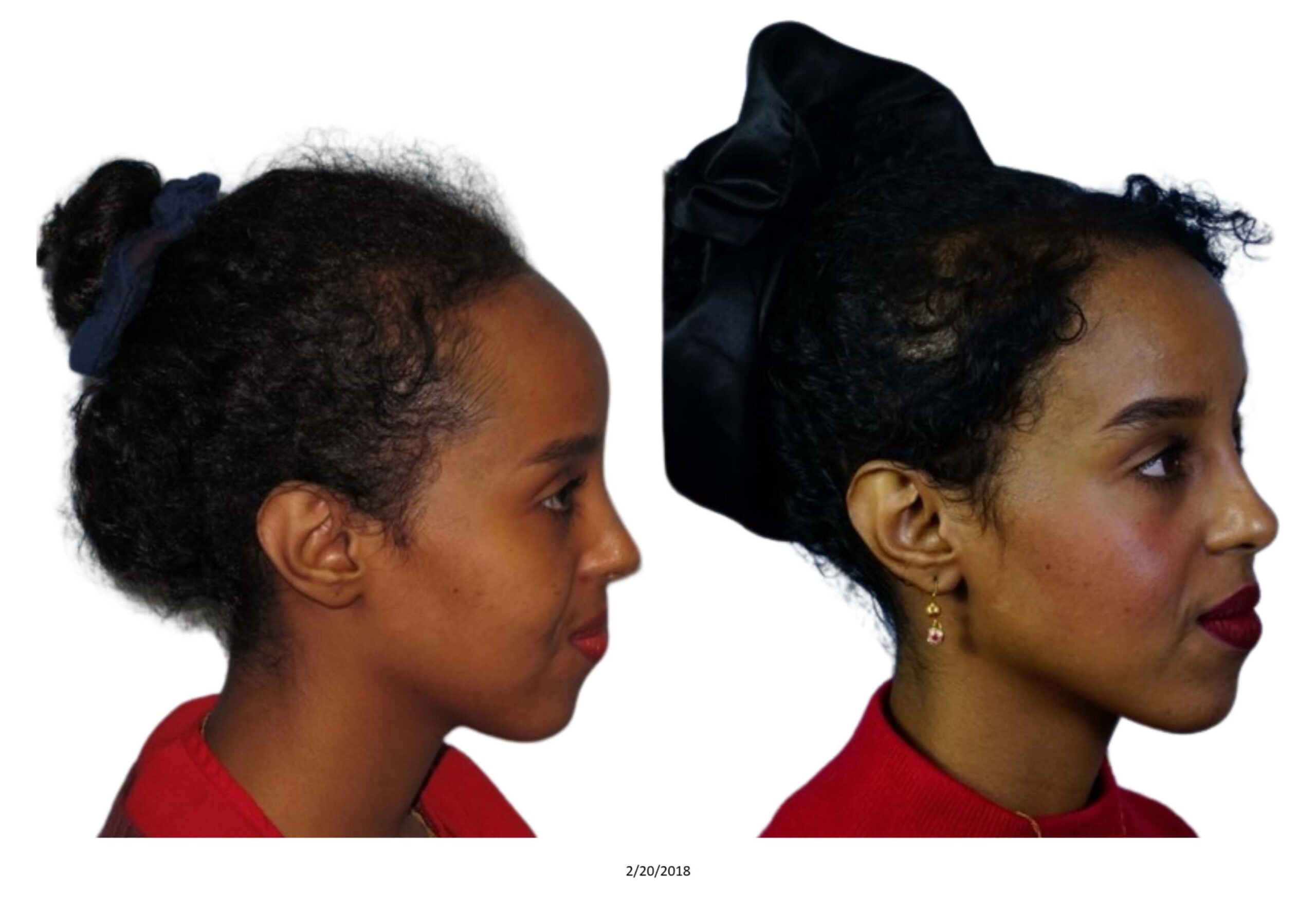 Female B&A_37_bw