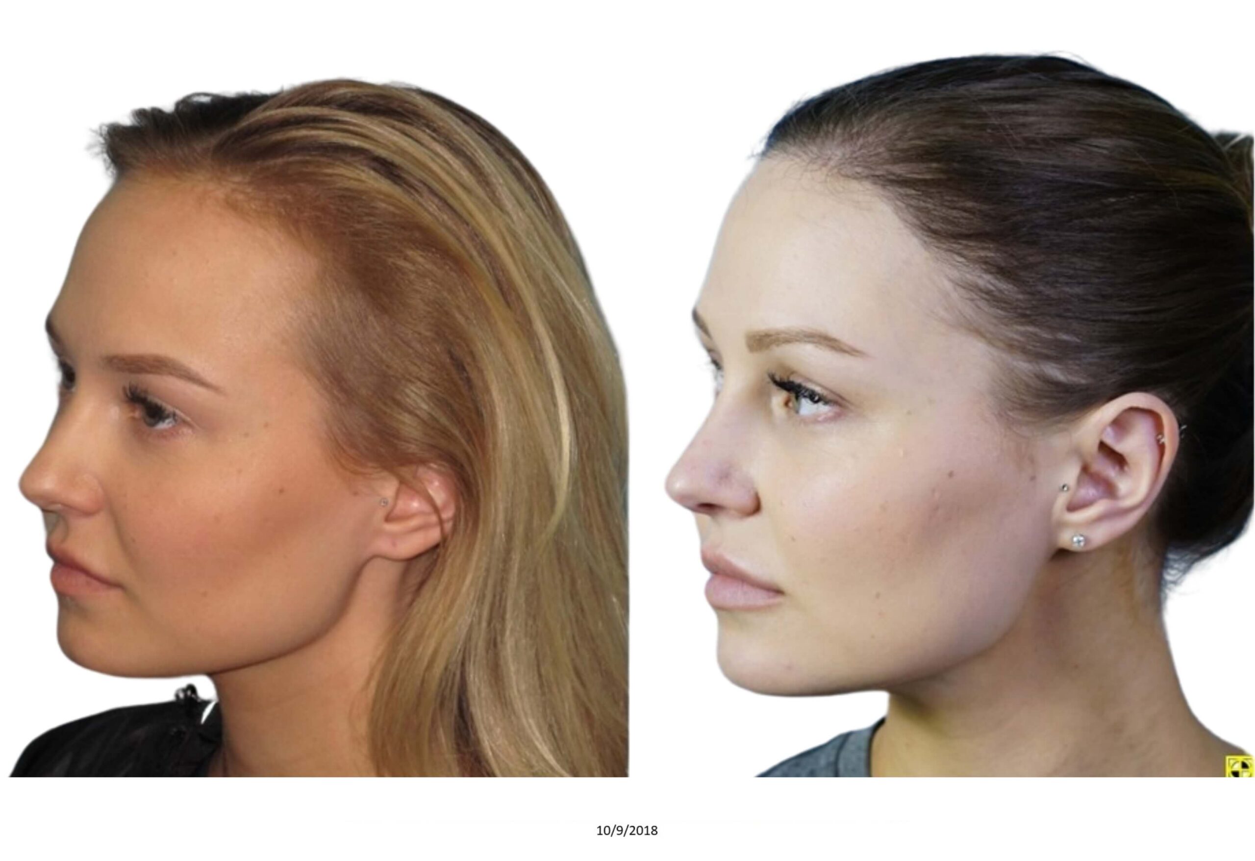 Female B&A_4_bw