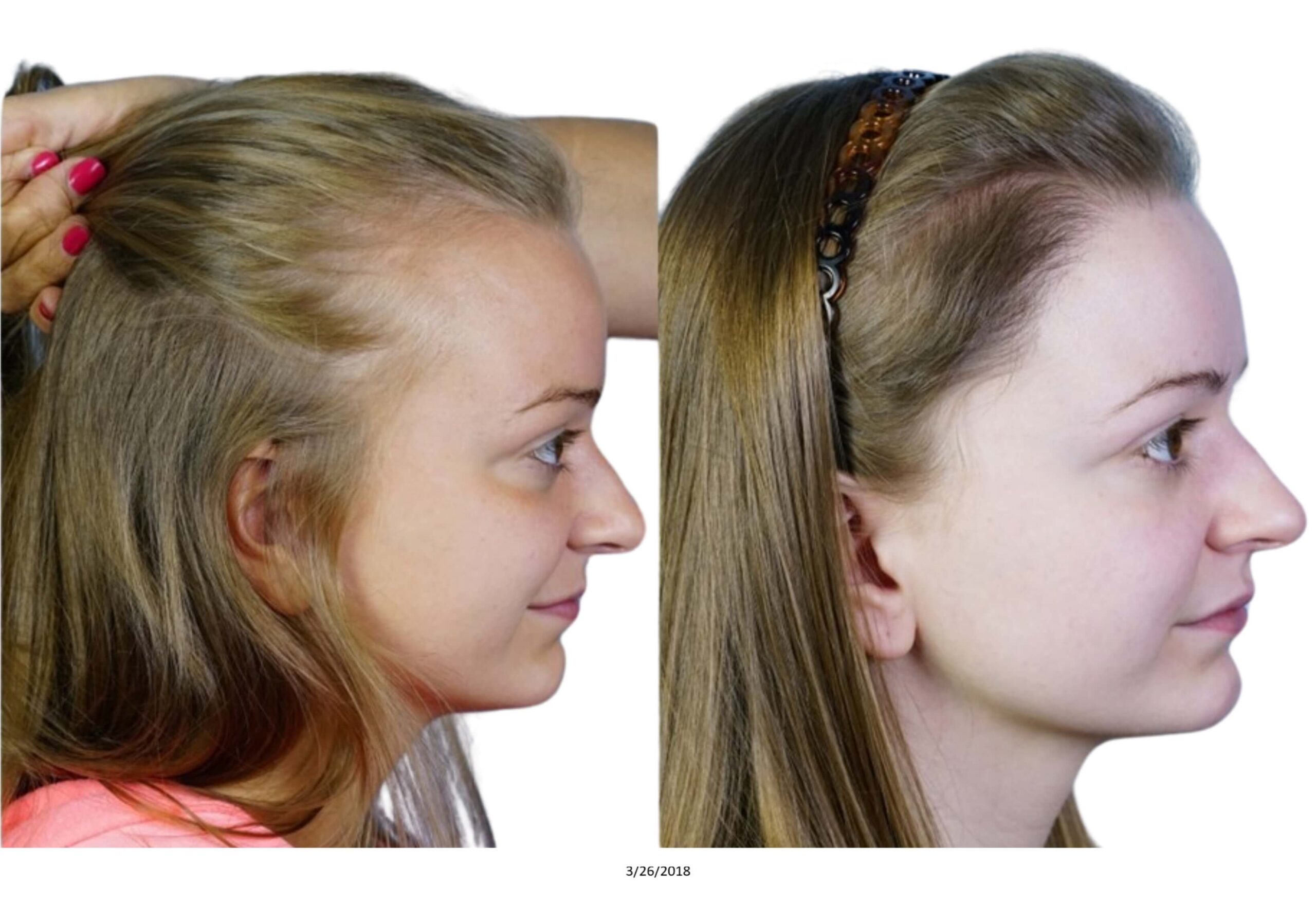 Female B&A_8_bw