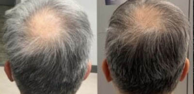 Alma-TED_before-after_p4
