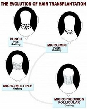 Evolution of Hair Transplantation