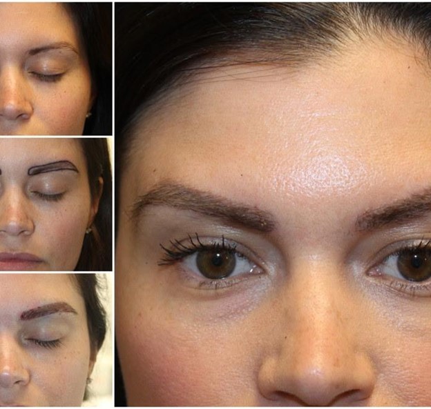 Eyebrow Hair Restoration