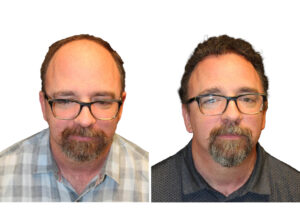 Male Before and After Hair Transplant