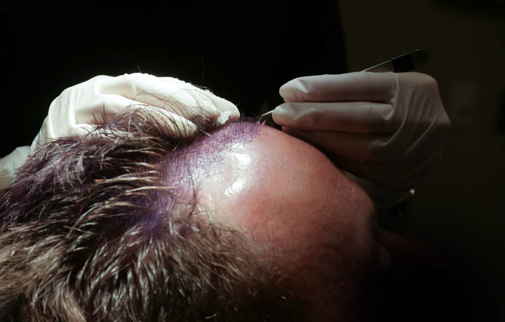 Male FUE Procedure Male FUE Procedure