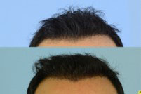 SMP for Thinning Hairlines
