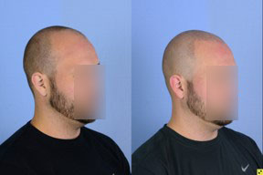 SMP for the shaved look