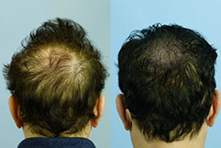 SMP for Thickening