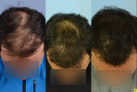 SMP for Post Hair Transplant