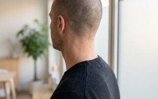 Man with buzz cut showing even scalp tone after scalp micropigmentation for FUE scars
